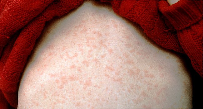 2019 Measles Outbreak: What You Should Know